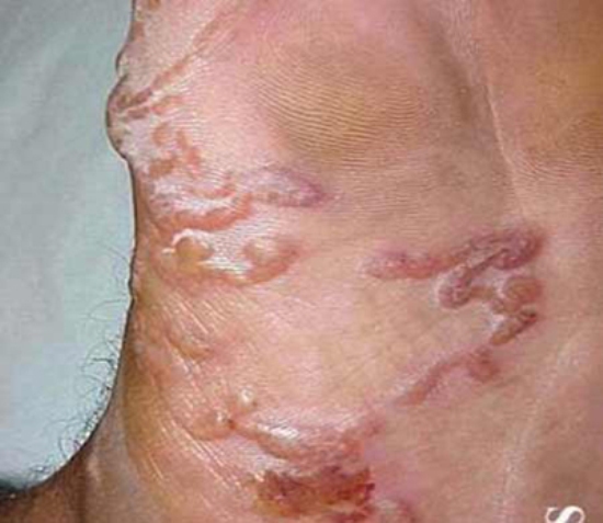Bệnh giun lươn nguy hiểm nhưng ít người biết